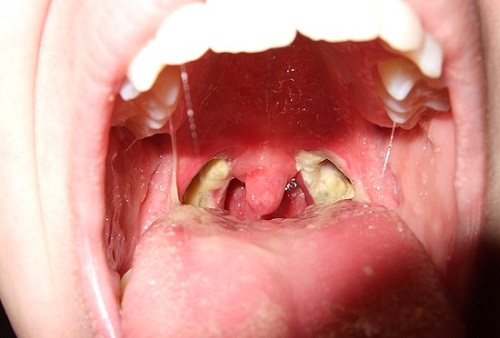 Bad Taste In Throat When Swallowing 33
