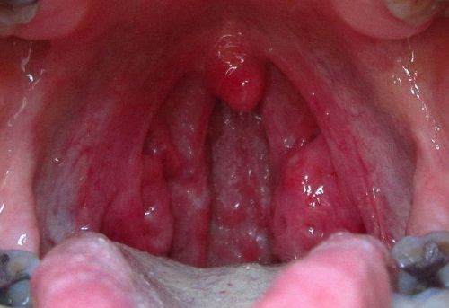 bacterial infection on lip #10