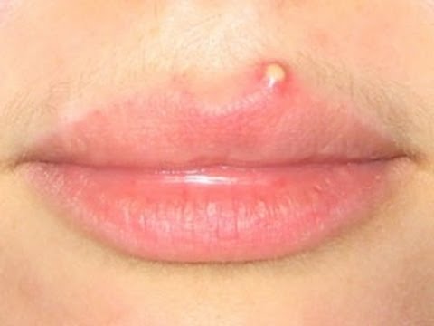 Oral Fordyce Spots on the Lips and Around the Mouth