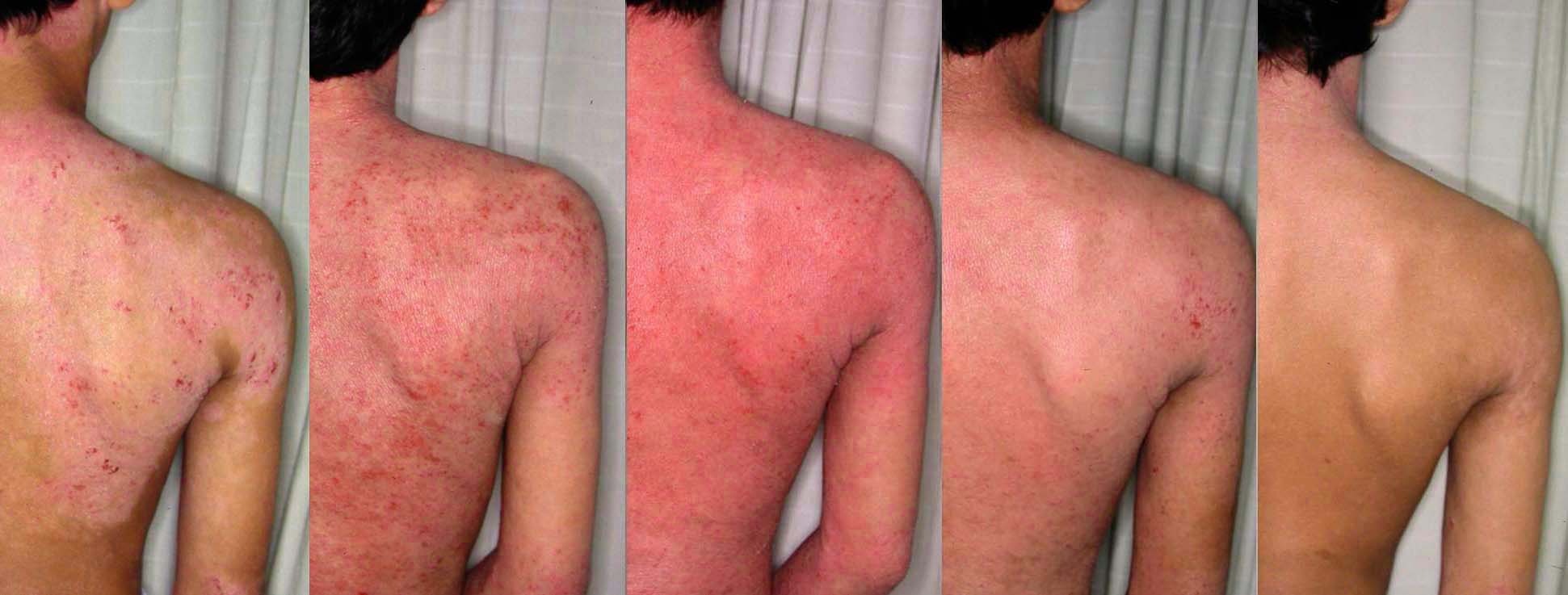 Atopic dermatitis (eczema) Symptoms - Mayo Clinic
