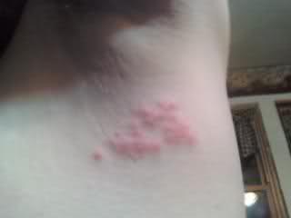 red bumps under armpit #11