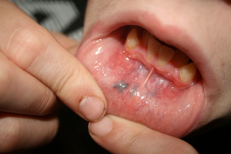 blister inside of bottom lip? | Yahoo Answers